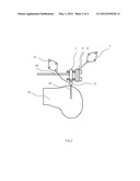 REDUCED INVASIVITY FIXATION SYSTEM FOR TRACKERS IN COMPUTER ASSISTED     SURGERY diagram and image