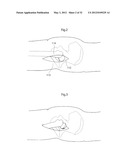 HIP JOINT INSTRUMENT AND METHOD diagram and image