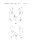 HIP JOINT INSTRUMENT AND METHOD diagram and image