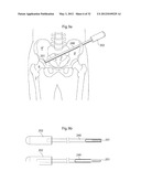 HIP JOINT INSTRUMENT AND METHOD diagram and image