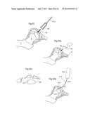 HIP JOINT INSTRUMENT AND METHOD diagram and image