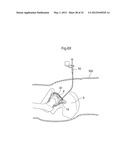 HIP JOINT INSTRUMENT AND METHOD diagram and image