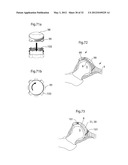 HIP JOINT INSTRUMENT AND METHOD diagram and image