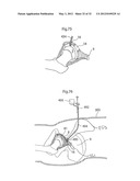 HIP JOINT INSTRUMENT AND METHOD diagram and image