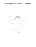 LEADLESS CARDIAC PACEMAKER WITH CONDUCTED COMMUNICATION diagram and image