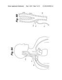 IMPLANT TOOL AND IMPROVED ELECTRODE DESIGN FOR MINIMALLY INVASIVE     PROCEDURE diagram and image