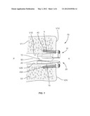 SPINAL IMPLANT diagram and image