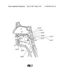 AIRWAY IMPLANTS AND METHODS AND DEVICES FOR INSERTION AND RETRIEVAL diagram and image