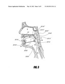 AIRWAY IMPLANTS AND METHODS AND DEVICES FOR INSERTION AND RETRIEVAL diagram and image