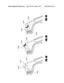 AIRWAY IMPLANTS AND METHODS AND DEVICES FOR INSERTION AND RETRIEVAL diagram and image