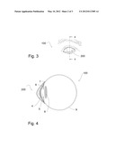 HYPER-OSMOTIC EYE CONTACT LENS diagram and image