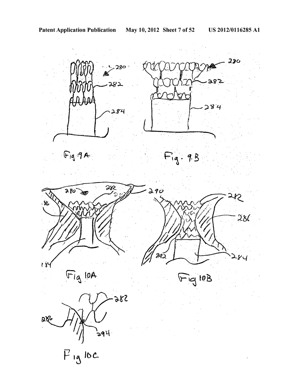 DEVICES FOR TREATING OBESITY AND METHODS OF USING THOSE DEVICES - diagram, schematic, and image 08