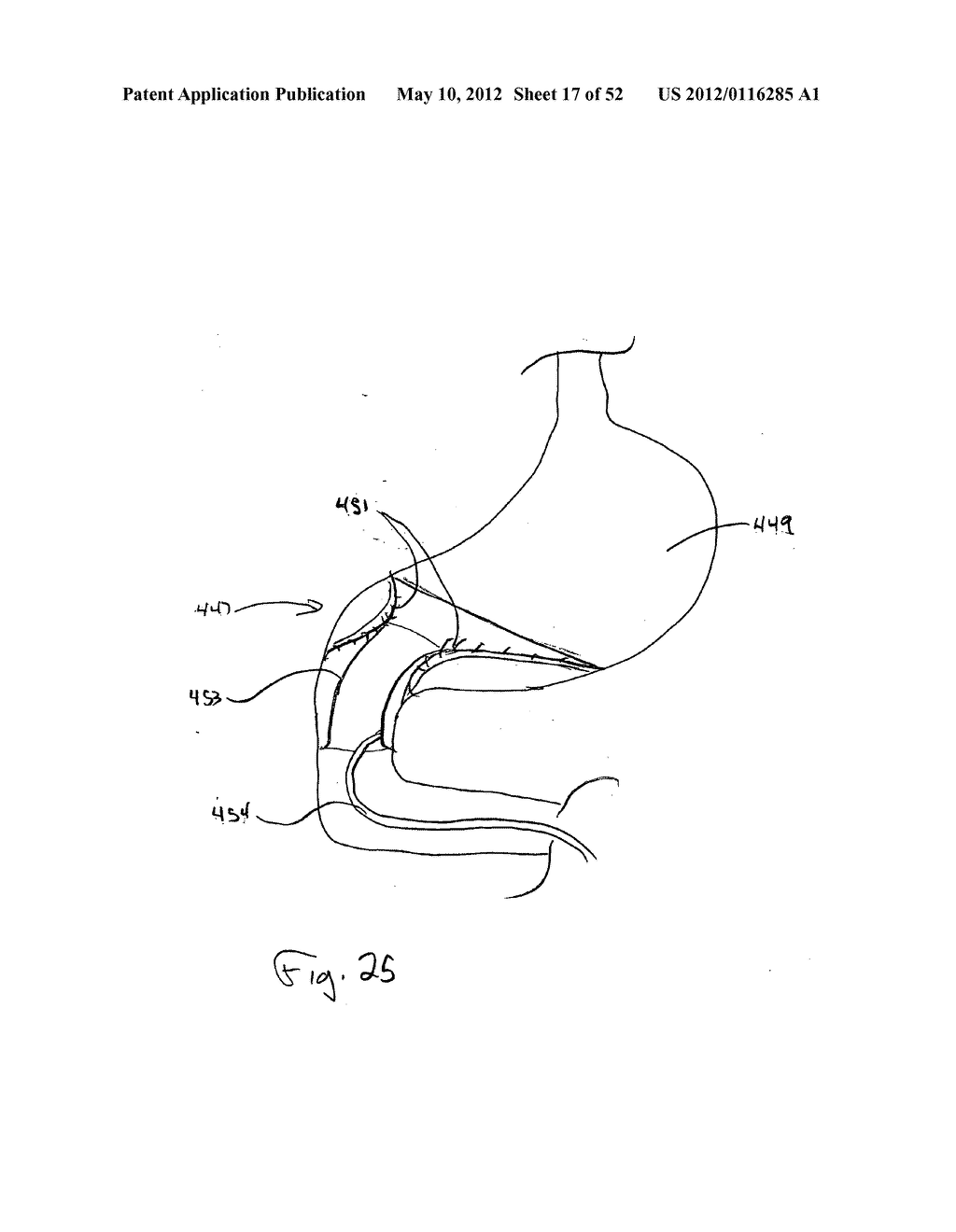 DEVICES FOR TREATING OBESITY AND METHODS OF USING THOSE DEVICES - diagram, schematic, and image 18