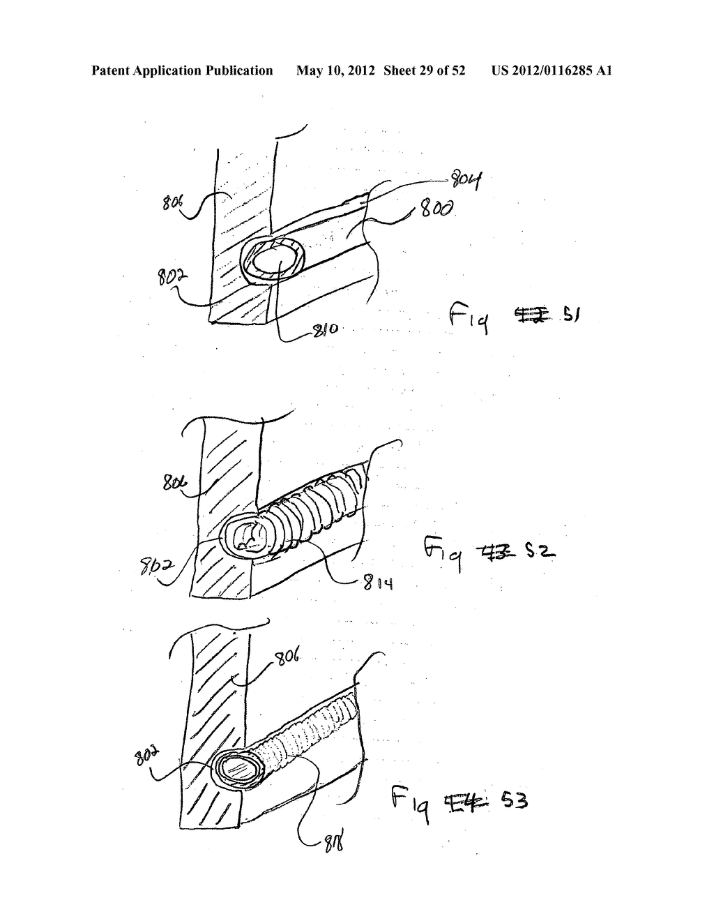 DEVICES FOR TREATING OBESITY AND METHODS OF USING THOSE DEVICES - diagram, schematic, and image 30