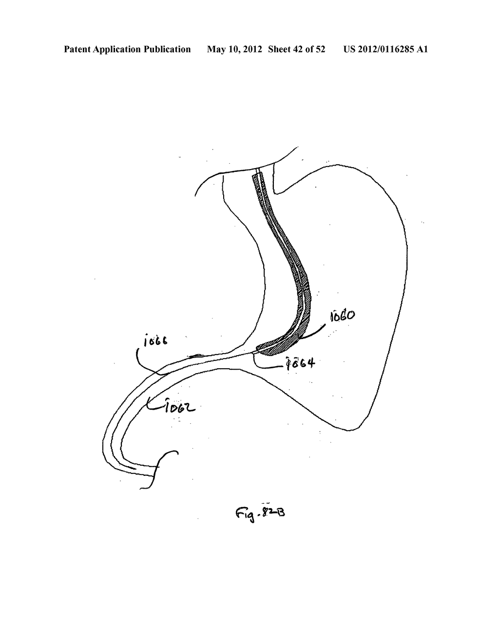 DEVICES FOR TREATING OBESITY AND METHODS OF USING THOSE DEVICES - diagram, schematic, and image 43