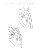 SHOCKWAVE VALVULOPLASTY DEVICE WITH GUIDEWIRE AND DEBRIS BASKET diagram and image