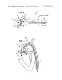 SHOCKWAVE VALVULOPLASTY DEVICE WITH GUIDEWIRE AND DEBRIS BASKET diagram and image