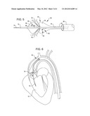 SHOCKWAVE VALVULOPLASTY DEVICE WITH GUIDEWIRE AND DEBRIS BASKET diagram and image