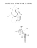 IMPLANTABLE MEDICAL DEVICE FOR LUBRICATING AN ARTIFICIAL CONTACTING     SURFACE AND METHOD OF IMPLANTING THE DEVICE diagram and image