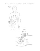 IMPLANTABLE MEDICAL DEVICE FOR LUBRICATING AN ARTIFICIAL CONTACTING     SURFACE AND METHOD OF IMPLANTING THE DEVICE diagram and image