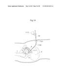 IMPLANTABLE MEDICAL DEVICE FOR LUBRICATING AN ARTIFICIAL CONTACTING     SURFACE AND METHOD OF IMPLANTING THE DEVICE diagram and image