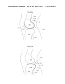 IMPLANTABLE MEDICAL DEVICE FOR LUBRICATING AN ARTIFICIAL CONTACTING     SURFACE AND METHOD OF IMPLANTING THE DEVICE diagram and image