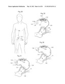 IMPLANTABLE MEDICAL DEVICE FOR LUBRICATING AN ARTIFICIAL CONTACTING     SURFACE AND METHOD OF IMPLANTING THE DEVICE diagram and image