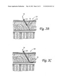 SURGICAL INSERTION APPARATUS diagram and image