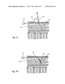 SURGICAL INSERTION APPARATUS diagram and image