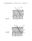 SURGICAL INSERTION APPARATUS diagram and image