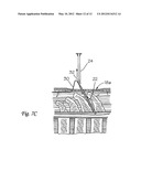 SURGICAL INSERTION APPARATUS diagram and image