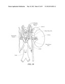 CATHETER APPARATUSES HAVING MULTI-ELECTRODE ARRAYS FOR RENAL     NEUROMODULATION AND ASSOCIATED SYSTEMS AND METHODS diagram and image