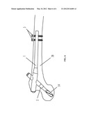 FIXATION DEVICE FOR INTRAMEDULLARY NAIL diagram and image