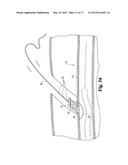 DEVICES AND METHODS USEFUL FOR SEALING BODILY OPENINGS diagram and image