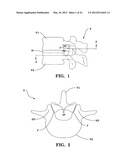 SYSTEMS AND METHODS FOR FACET JOINT STABILIZATION diagram and image