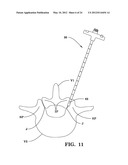 SYSTEMS AND METHODS FOR FACET JOINT STABILIZATION diagram and image