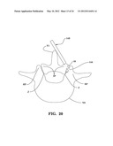 SYSTEMS AND METHODS FOR FACET JOINT STABILIZATION diagram and image