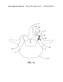 SYSTEMS AND METHODS FOR FACET JOINT STABILIZATION diagram and image