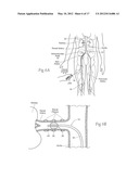 MICROWAVE CATHETER APPARATUSES, SYSTEMS, AND METHODS FOR RENAL     NEUROMODULATION diagram and image