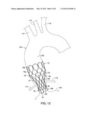 AORTIC VALVE PROSTHESES diagram and image