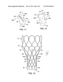 AORTIC VALVE PROSTHESES diagram and image