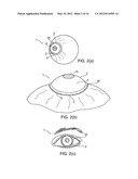 SYSTEM AND DEVICE FOR CORRECTING HYPEROPIA, MYOPIA AND PRESBYOPIA diagram and image