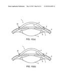 SYSTEM AND DEVICE FOR CORRECTING HYPEROPIA, MYOPIA AND PRESBYOPIA diagram and image