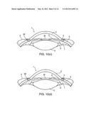 SYSTEM AND DEVICE FOR CORRECTING HYPEROPIA, MYOPIA AND PRESBYOPIA diagram and image