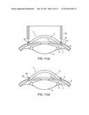 SYSTEM AND DEVICE FOR CORRECTING HYPEROPIA, MYOPIA AND PRESBYOPIA diagram and image