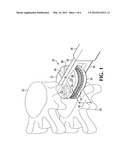 Anatomic total disc replacement diagram and image