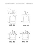 METHOD AND APPARATUS FOR THE TREATMENT OF THE INTERVERTEBRAL DISC ANNULUS diagram and image