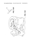 METHOD AND APPARATUS FOR THE TREATMENT OF THE INTERVERTEBRAL DISC ANNULUS diagram and image