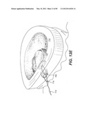 METHOD AND APPARATUS FOR THE TREATMENT OF THE INTERVERTEBRAL DISC ANNULUS diagram and image