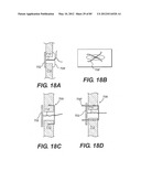 METHOD AND APPARATUS FOR THE TREATMENT OF THE INTERVERTEBRAL DISC ANNULUS diagram and image